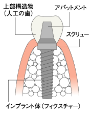 インプラントの構造
